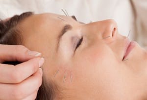 acupuncture for migraine