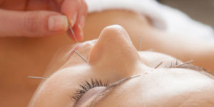 acupuncture on the face