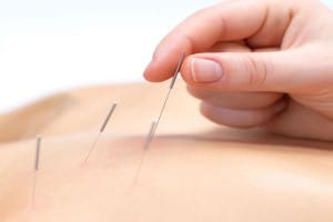 acupuncture treatment