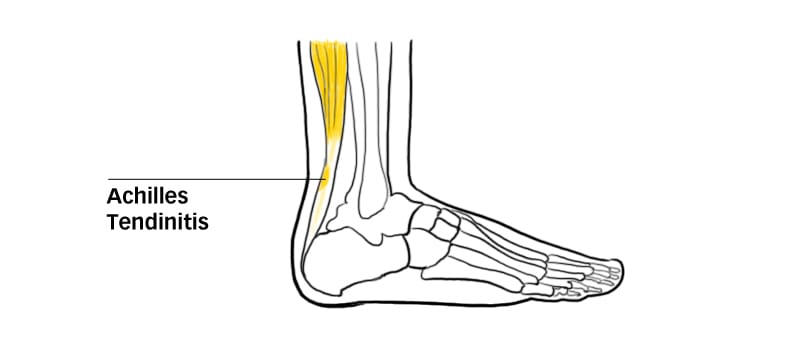 Achilles-tendinitis