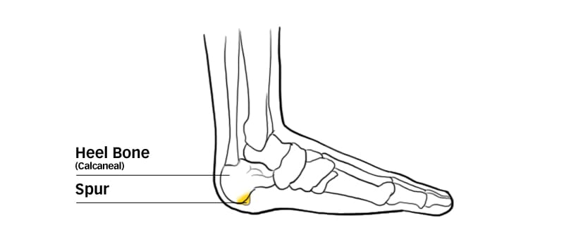 Heel-Spur
