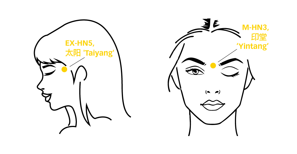 Migraine-taiyang-yintang