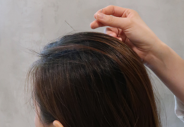 acupuncture on the head