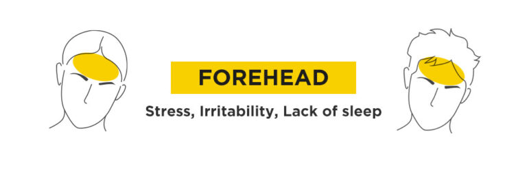 What is the TCM Acne Mapping for Forehead Acne