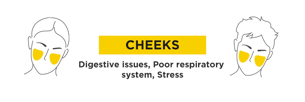 What is the TCM Acne Mapping for Cheeks Acne