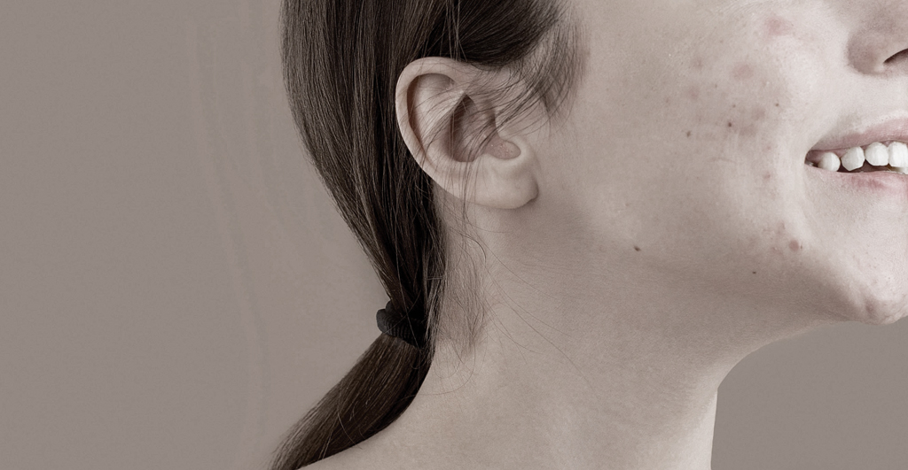 TCM perspective How certain foods can cause acne 1