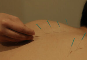 acupuncture